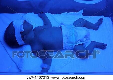 Premature baby with jaundice having phototherapy View Large Photo Image Stock Image - Premature baby with jaundice having phototherapy. Fotosearch