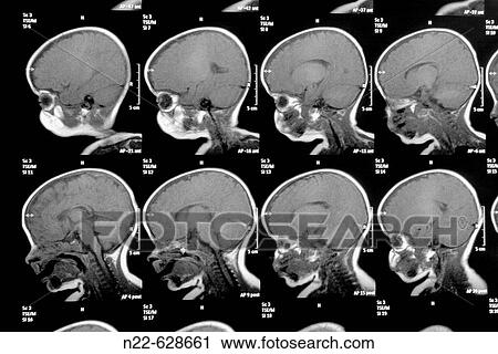 Stock Image - Sagittal view of a child brain.. Fotosearch