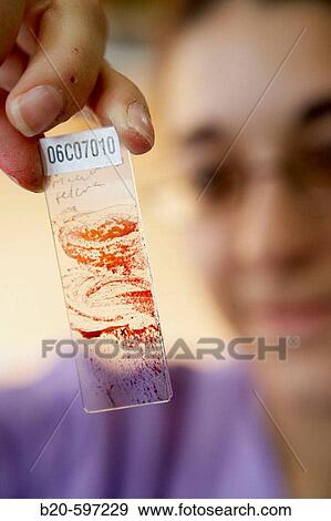 Sample, Pathological anatomy. Hospital de Zumarraga, Gipuzkoa, Euskadi, Spain View Large Photo Image Stock Photo - Sample, Pathological anatomy. Hospital de Zumarraga, Gipuzkoa, Euskadi, Spain. Fotosearch