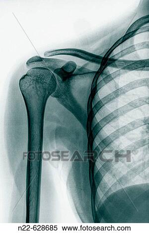 Shoulder bones X-rays. View Large Photo Image Stock Photography - Shoulder bones X-rays.. Fotosearch