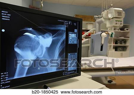 Shoulder X-ray, Radiology Department, Donostia Hospital, San Sebastian, Donostia, Gipuzkoa, Basque Country, Spain View Large Photo Image Stock Photography - Shoulder X-ray, Radiology Department, Donostia Hospital, San Sebastian, Donostia, Gipuzkoa, Basque Country, Spain. Fotosearch