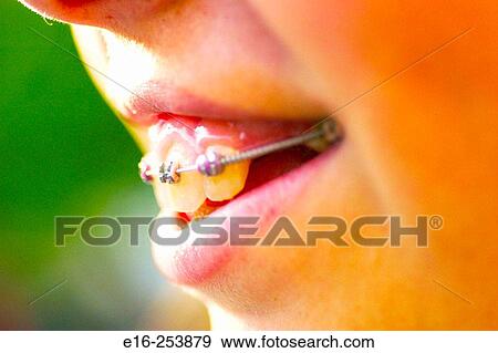 smiling girl with braces View Large Photo Image Stock Photo - smiling girl with braces. Fotosearch