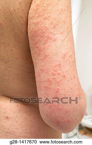 Summer Rash View Large Photo Image Stock Image - Summer Rash. Fotosearch