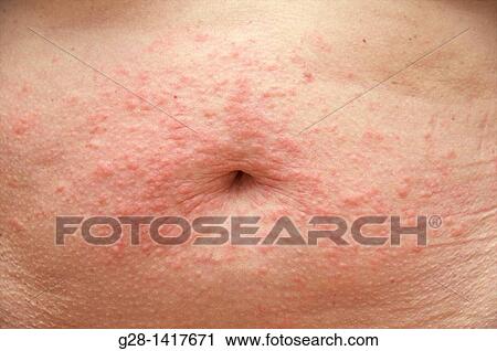 Stock Image - Summer Rash. Fotosearch