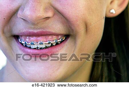 teenager with braces View Large Photo Image Stock Image - teenager with braces. Fotosearch