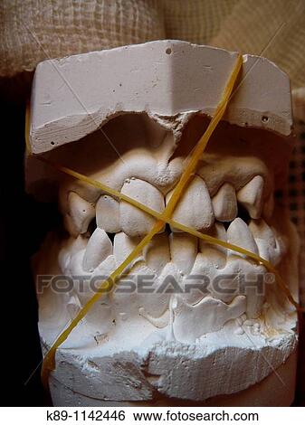Teeth mold View Large Photo Image Stock Photograph - Teeth mold. Fotosearch
