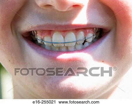 teeth retainer View Large Photo Image Stock Image - teeth retainer. Fotosearch