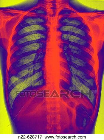 Thorax X-rays. View Large Photo Image Stock Photo - Thorax X-rays.. Fotosearch