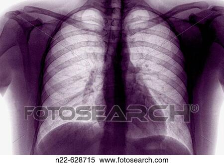 Thorax X-rays. View Large Photo Image Stock Photography - Thorax X-rays.. Fotosearch