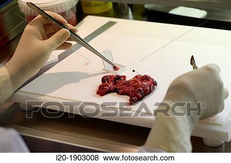 tissue sample selection Thyroid, Anatomic Pathology, Onkologikoa Hospital, Oncology Institute, Case Center for prevention, diagnosis and treatment of cancer, Donostia, San Sebastian, Gipuzkoa, Basque Country, Spain View Large Photo Image Stock Photo - tissue sample selection Thyroid, Anatomic Pathology, Onkologikoa Hospital, Oncology Institute, Case Center for prevention, diagnosis and treatment of cancer, Donostia, San Sebastian, Gipuzkoa, Basque Country, Spain. Fotosearch