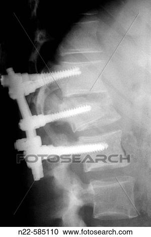 Titanium fixations on spine, compression fractures caused by car accident View Large Photo Image Stock Image - Titanium fixations on spine, compression fractures caused by car accident. Fotosearch