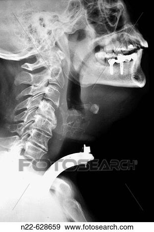 Stock Photo - Tracheotomy or tracheostomy. X-rays with tracheal cannula.. Fotosearch
