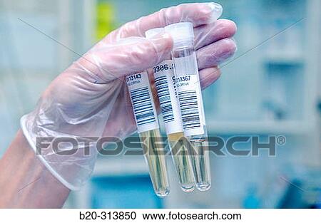 Stock Image - Urine samples to analyze at laboratory of hospital. Fotosearch
