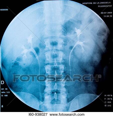urografia, kidney View Large Photo Image Stock Photo - urografia, kidney. Fotosearch