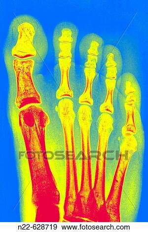 Stock Photo - Vista dorsal radiografia pie. Fotosearch