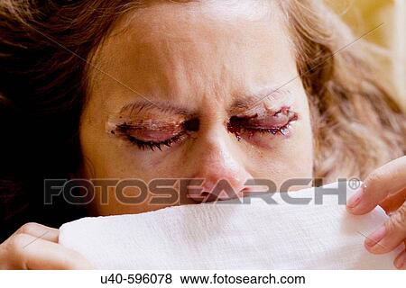 Woman after cosmetic eye surgery View Large Photo Image Stock Photo - Woman after cosmetic eye surgery. Fotosearch