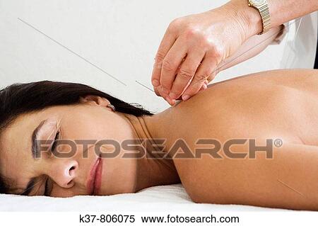 Woman having acupuncture therapy View Large Photo Image Stock Photography - Woman having acupuncture therapy. Fotosearch