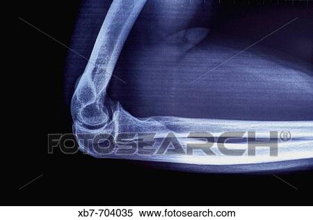 X-Ray, arm and elbow View Large Photo Image Stock Photography - X-Ray, arm and elbow. Fotosearch