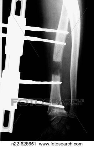 X-ray of arm with fixations for fracture. View Large Photo Image Stock Image - X-ray of arm with fixations for fracture.. Fotosearch