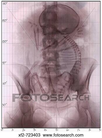 Stock Image - X-Ray of fetus. Fotosearch