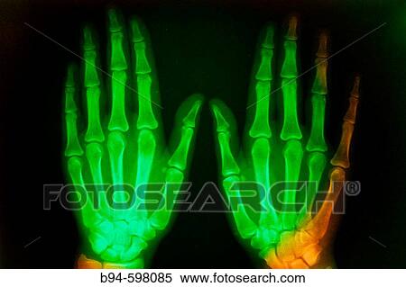 X-ray of hands View Large Photo Image Stock Photography - X-ray of hands. Fotosearch