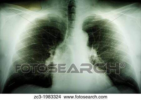 X-ray of lungs damaged. View Large Photo Image Picture - X-ray of lungs damaged.. Fotosearch