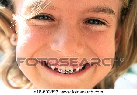 Young girl with braces View Large Photo Image Stock Photo - Young girl with braces. Fotosearch