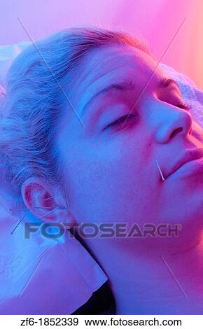 Stock Photo - Young woman patient of acupunture getting ear and face needles treatment for pain and allergies. Fotosearch
