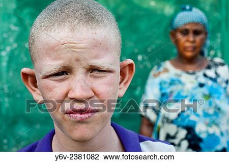 Stock Image - Albino boy with his mother ( Ethiopia).. Fotosearch
