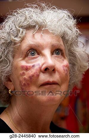 Stock Image - laser burnt senior woman cheeks for age spots.. Fotosearch