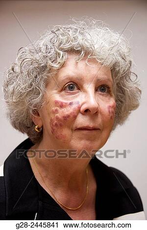 laser burnt senior woman cheeks for age spots. View Large Photo Image Stock Image - laser burnt senior woman cheeks for age spots.. Fotosearch