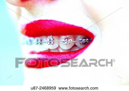 Close up of woman mouth with braces.. View Large Photo Image Stock Photo - Close up of woman mouth with braces... Fotosearch