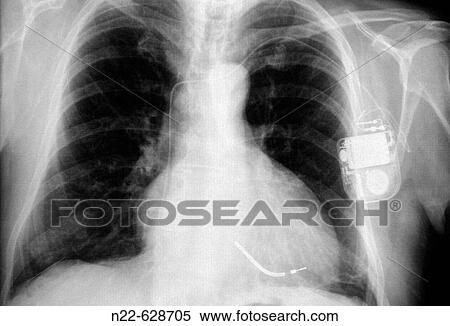 Pacemaker View Large Photo Image Stock Photography - Pacemaker. Fotosearch