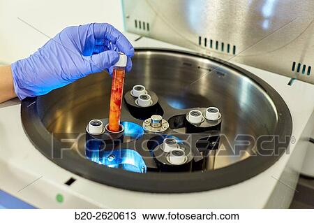 Centrifuge fat. Lipofilling. Fat Grafting. Liposculpture. Lipofilling is based on patients own fat transfer to another area, either for body shaping and facial rejuvenation. The fat is removed by liposuction of the donor site, usually lower abdomen or thi View Large Photo Image Stock Image - Centrifuge fat. Lipofilling. Fat Grafting. Liposculpture. Lipofilling is based on patients own fat transfer to another area, either for body shaping and facial rejuvenation. The fat is removed by liposuction of the donor site, usually lower abdomen or thi. Fotosearch