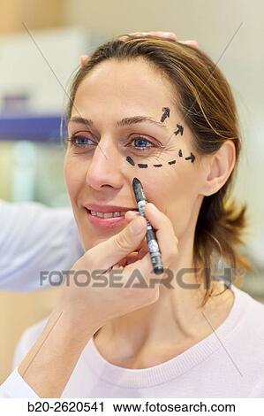 Stock Image - Facelift. Blepharoplasty. Rhytidoplasty. It involves stretching the facial skin in order to remove wrinkles. Before surgery it is necessary to mark the facial aesthetic units and choose the voltage vectors that apply in the intervention. Plastic surgery. . Fotosearch