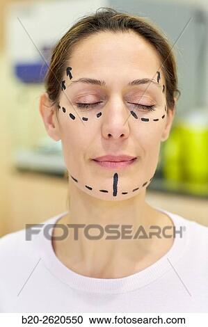 Facelift. Blepharoplasty. Rhytidoplasty. It involves stretching the facial skin in order to remove wrinkles. Before surgery it is necessary to mark the facial aesthetic units and choose the voltage vectors that apply in the intervention. Plastic surgery. View Large Photo Image Stock Image - Facelift. Blepharoplasty. Rhytidoplasty. It involves stretching the facial skin in order to remove wrinkles. Before surgery it is necessary to mark the facial aesthetic units and choose the voltage vectors that apply in the intervention. Plastic surgery. . Fotosearch