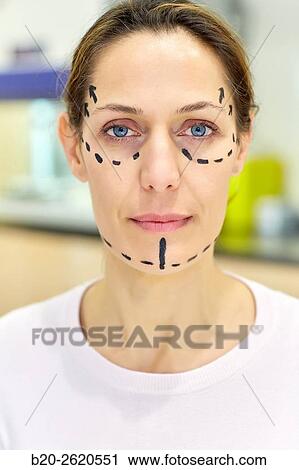 Facelift. Blepharoplasty. Rhytidoplasty. It involves stretching the facial skin in order to remove wrinkles. Before surgery it is necessary to mark the facial aesthetic units and choose the voltage vectors that apply in the intervention. Plastic surgery. View Large Photo Image Stock Image - Facelift. Blepharoplasty. Rhytidoplasty. It involves stretching the facial skin in order to remove wrinkles. Before surgery it is necessary to mark the facial aesthetic units and choose the voltage vectors that apply in the intervention. Plastic surgery. . Fotosearch