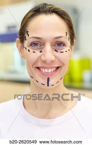 Stock Photo - Facelift. Blepharoplasty. Rhytidoplasty. It involves stretching the facial skin in order to remove wrinkles. Before surgery it is necessary to mark the facial aesthetic units and choose the voltage vectors that apply in the intervention. Plastic surgery. . Fotosearch