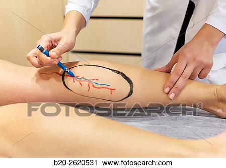 Leg. Flap. Reconstructive surgery limbs. Flaps is one of the basic tools. It is to mobilize vascularized tissue through an artery and a vein to cover exposed areas after trauma. Plastic surgery. Doctor attending to patient medical consultation. View Large Photo Image Stock Image - Leg. Flap. Reconstructive surgery limbs. Flaps is one of the basic tools. It is to mobilize vascularized tissue through an artery and a vein to cover exposed areas after trauma. Plastic surgery. Doctor attending to patient medical consultation.. Fotosearch