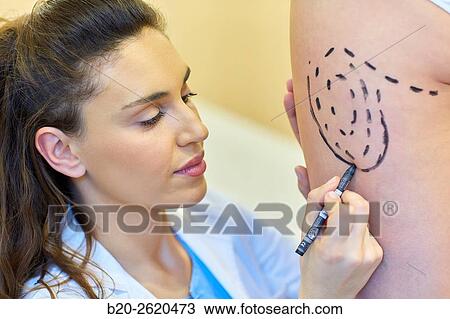 Liposuction. Liposculpture. It consists of aspiration cannulae of body fat deposits established. Before surgery a cartographic mapping of these deposits are made. Plastic surgery. Doctor attending to patient medical consultation. View Large Photo Image Stock Image - Liposuction. Liposculpture. It consists of aspiration cannulae of body fat deposits established. Before surgery a cartographic mapping of these deposits are made. Plastic surgery. Doctor attending to patient medical consultation.. Fotosearch