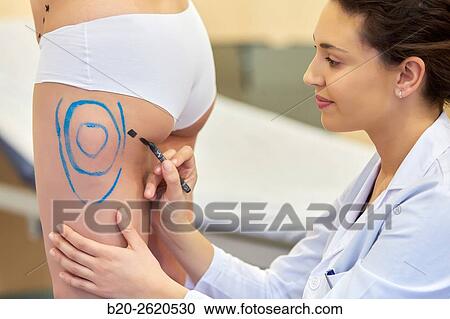 Liposuction. Liposculpture. It consists of aspiration cannulae of body fat deposits established. Before surgery a cartographic mapping of these deposits are made. Plastic surgery. Doctor attending to patient medical consultation. View Large Photo Image Stock Image - Liposuction. Liposculpture. It consists of aspiration cannulae of body fat deposits established. Before surgery a cartographic mapping of these deposits are made. Plastic surgery. Doctor attending to patient medical consultation.. Fotosearch