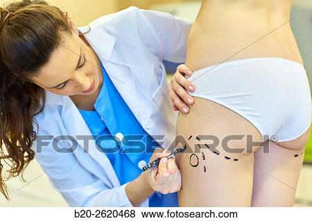 Liposuction. Liposculpture. It consists of aspiration cannulae of body fat deposits established. Before surgery a cartographic mapping of these deposits are made. Plastic surgery. Doctor attending to patient medical consultation. View Large Photo Image Stock Photo - Liposuction. Liposculpture. It consists of aspiration cannulae of body fat deposits established. Before surgery a cartographic mapping of these deposits are made. Plastic surgery. Doctor attending to patient medical consultation.. Fotosearch