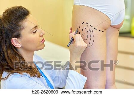 Liposuction. Liposculpture. It consists of aspiration cannulae of body fat deposits established. Before surgery a cartographic mapping of these deposits are made. Plastic surgery. Doctor attending to patient medical consultation. View Large Photo Image Stock Photo - Liposuction. Liposculpture. It consists of aspiration cannulae of body fat deposits established. Before surgery a cartographic mapping of these deposits are made. Plastic surgery. Doctor attending to patient medical consultation.. Fotosearch