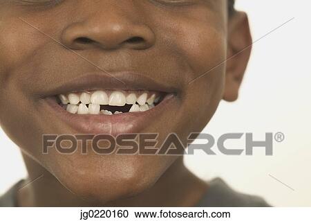 Stock Image - Close-up of a young boy smiling with broken teeth. Fotosearch