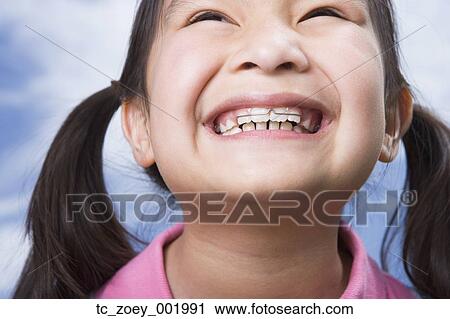 Stock Image - Close up of young Asian girl with orthodontics. Fotosearch