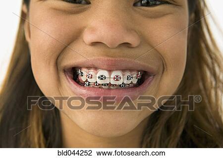 Stock Image - Asian girl smiling with braces. Fotosearch