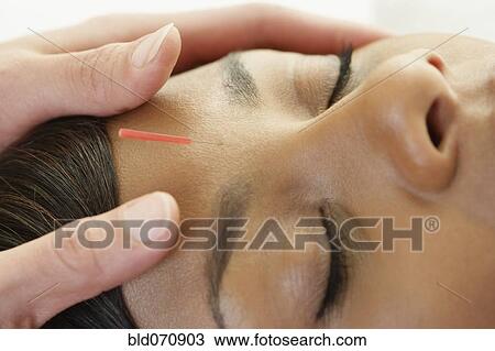 Acupuncture needle in African woman's forehead View Large Photo Image Stock Image - Acupuncture needle in African woman's forehead. Fotosearch