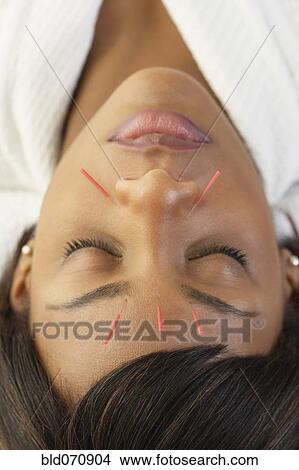Picture - Acupuncture needles in African woman's face. Fotosearch