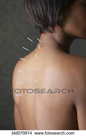 Picture - Acupuncture needles in African woman's back. Fotosearch