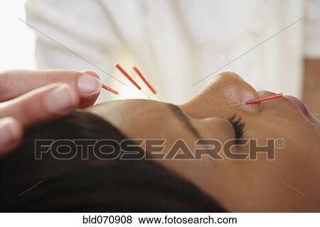 Acupuncture needles in African woman's face View Large Photo Image Stock Photo - Acupuncture needles in African woman's face. Fotosearch